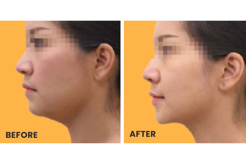 ultherapy before after